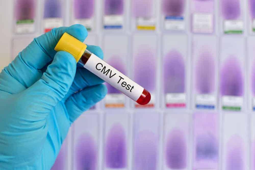 Infeksi Cytomegalovirus