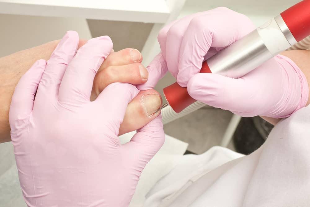 operasi-cantengan-operasi-ingrown-toenail