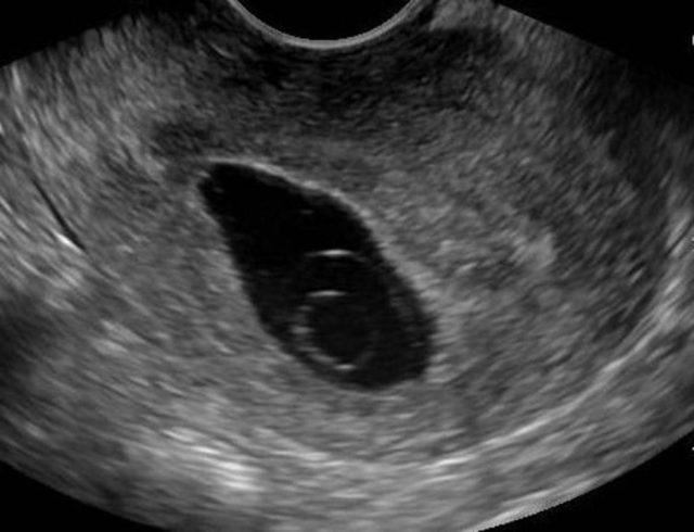 Blighted Ovum (Hamil Kosong), Ketika Sel Telur Tidak Berkembang Menjadi Embrio