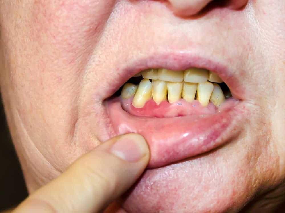 periodontitis-adalah