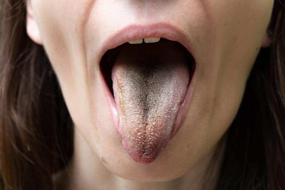 Leukoplakia