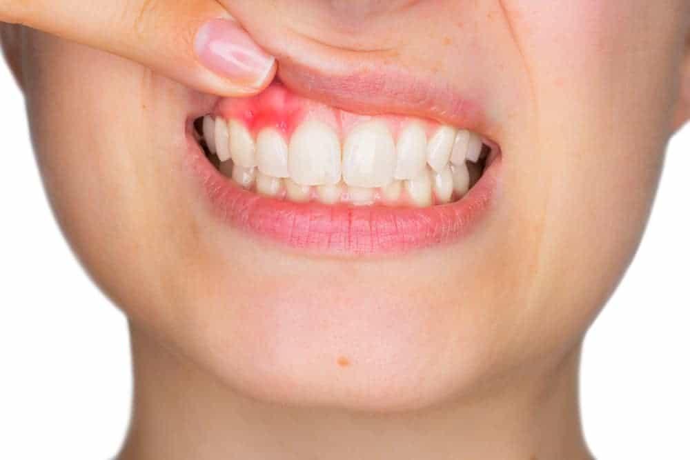 Gingivitis (Radang Gusi)