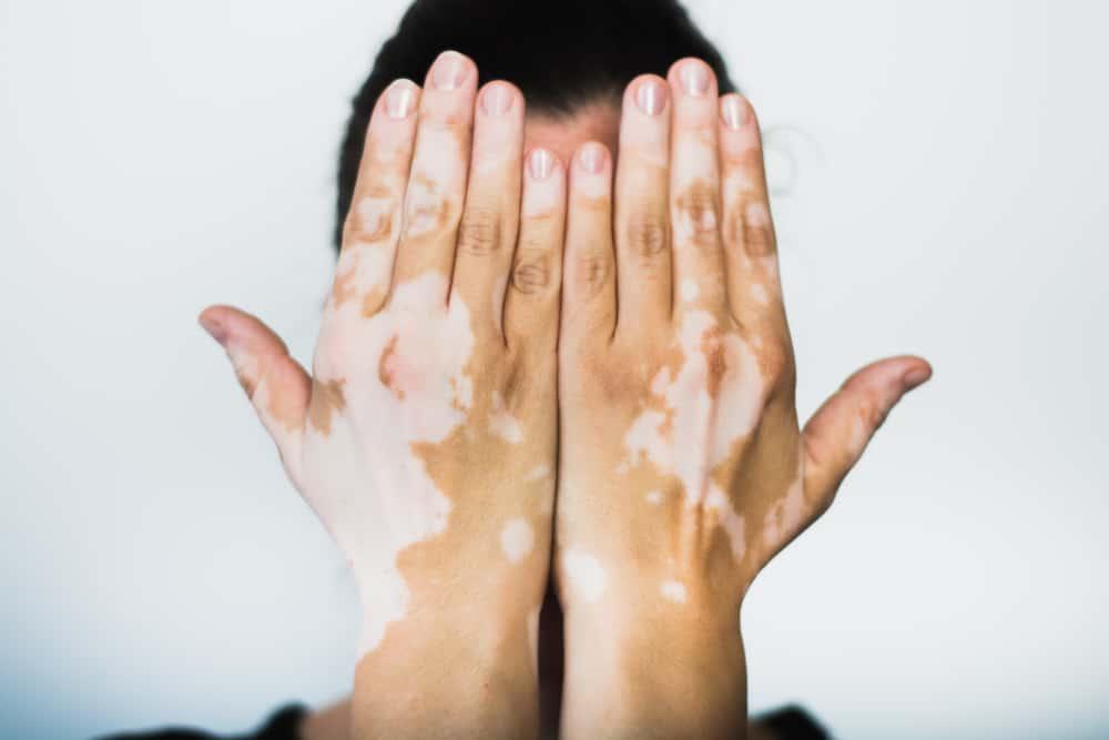 obat-vitiligo