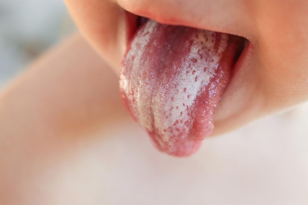 Infeksi Jamur di Mulut (Oral Thrush), dari Gejala hingga Pengobatannya