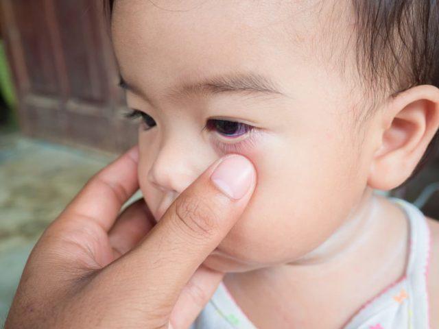 Bukan Karena Kurang Tidur, Ini 4 Penyebab Mata Panda Pada Si Kecil