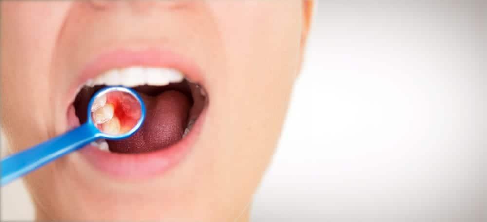 obat-radang-gusi-gingivitis