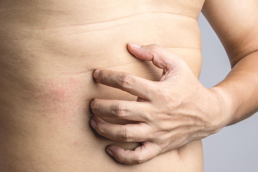 cara-mengatasi-biang-keringat