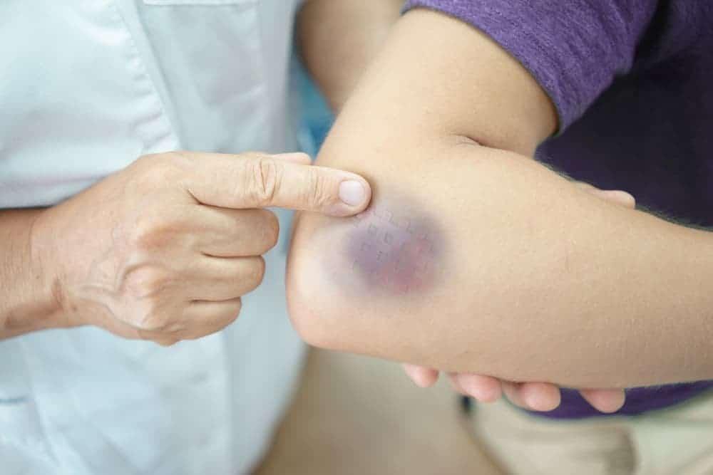 Mengenal Trombositosis, Saat Jumlah Trombosit Meningkat Secara Berlebihan