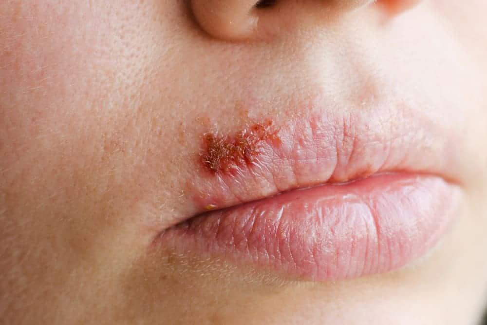Waspadai, Gejala dari Berbagai Macam Penyakit Herpes