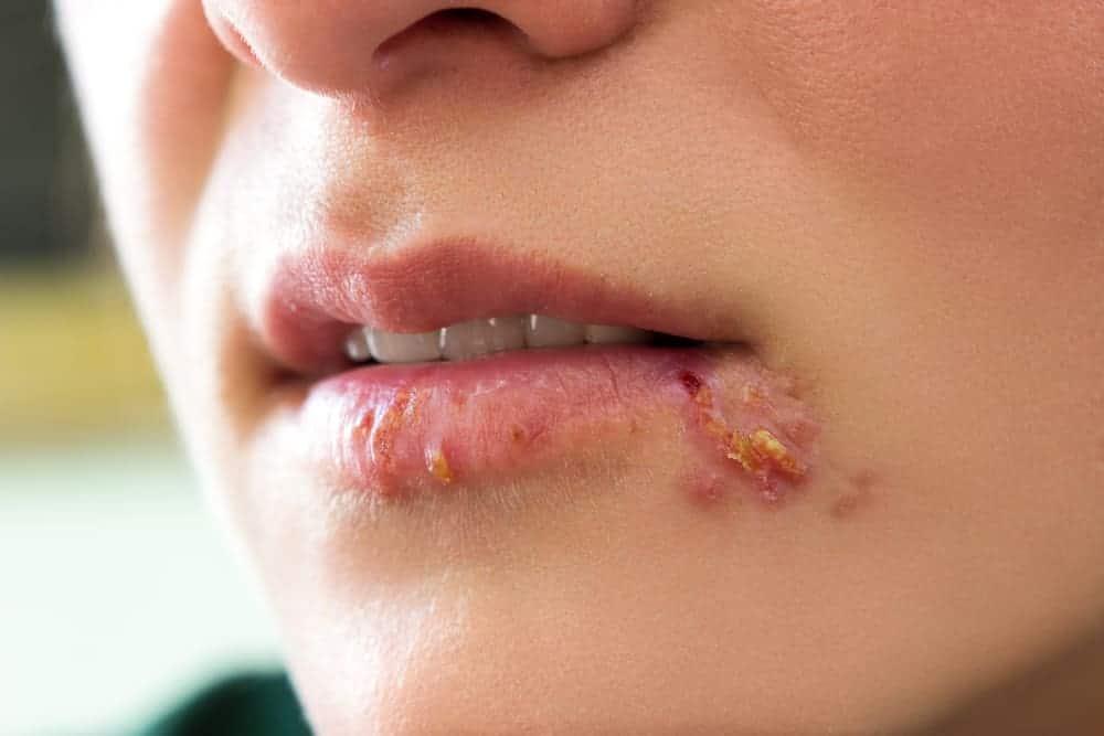 Mengenal Penyebab Penyakit Herpes Kulit dan Cara Mengatasinya