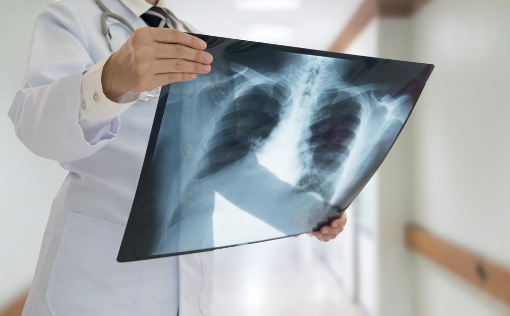 Tumor Mediastinum