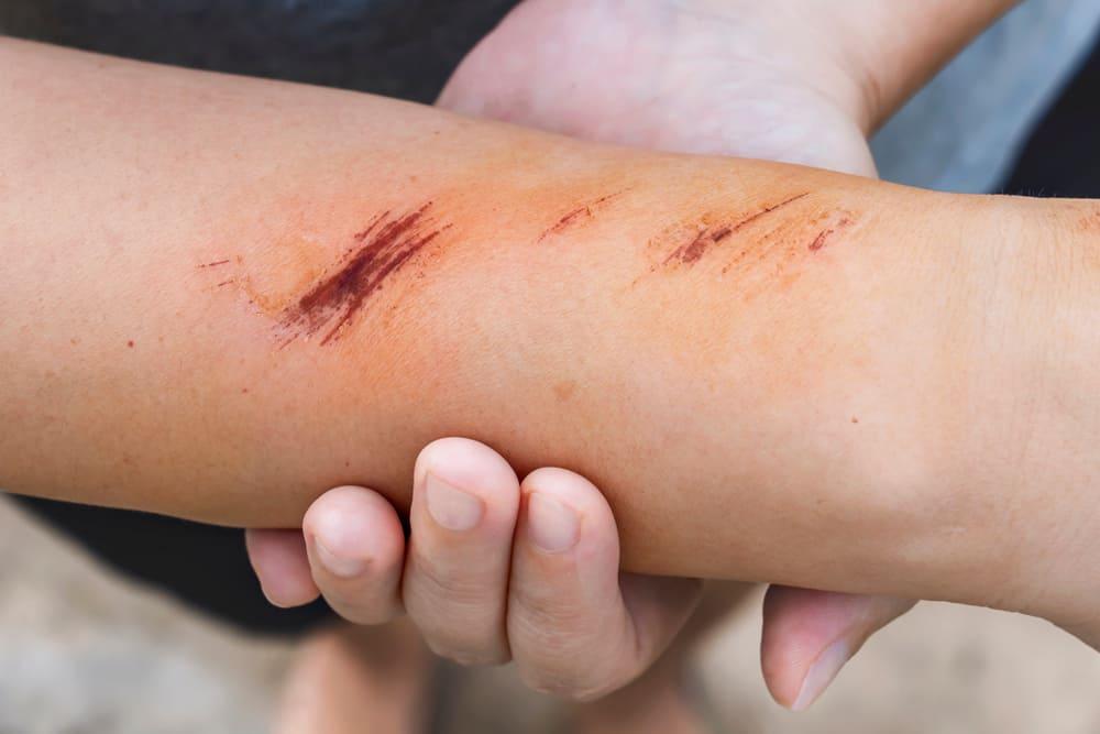 cara-menghilangkan-bekas-luka