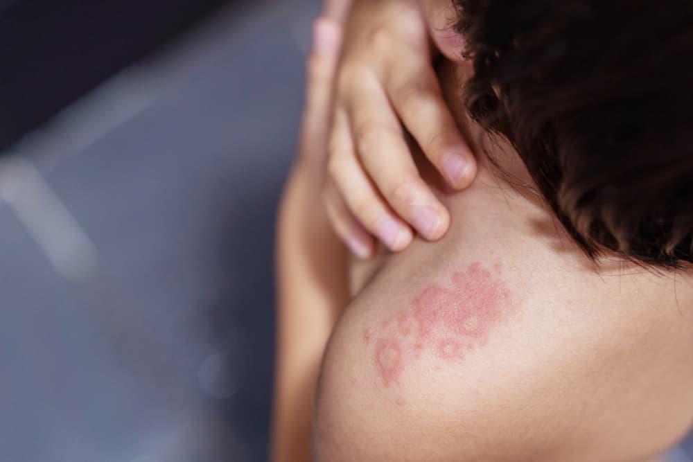 Pertolongan Pertama untuk Mengobati Gigitan Tomcat