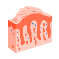 Psoriasis