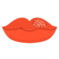 Herpes