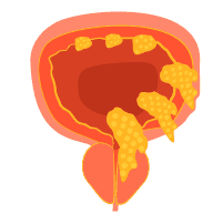 Kanker Kandung Kemih