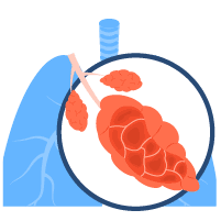 Emfisema