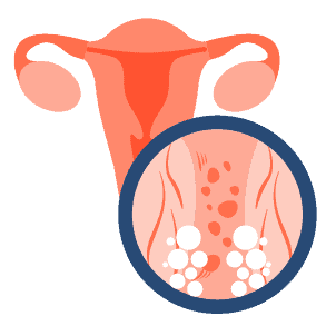 Fibroid Rahim