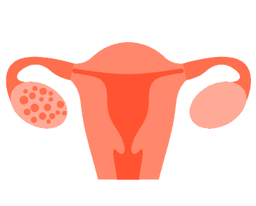 Sindrom Polikistik Ovarium (PCOS)