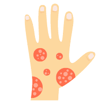 Dermatitis