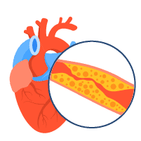 Aterosklerosis