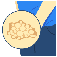 Herpes Genital dan Oral