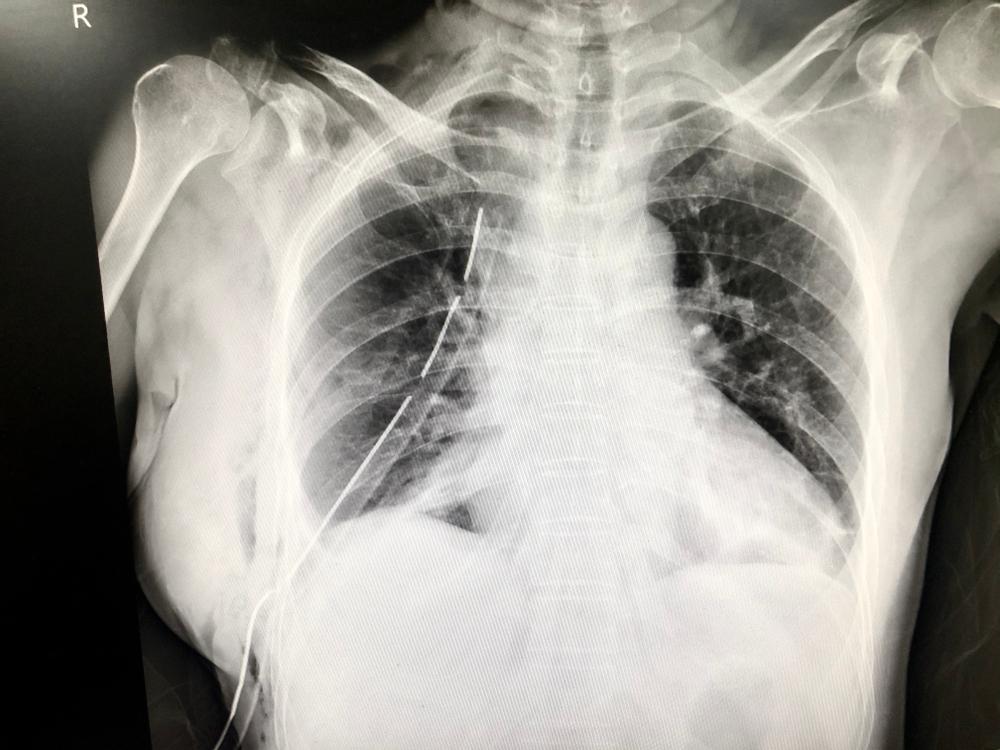 chest-drain-insertion