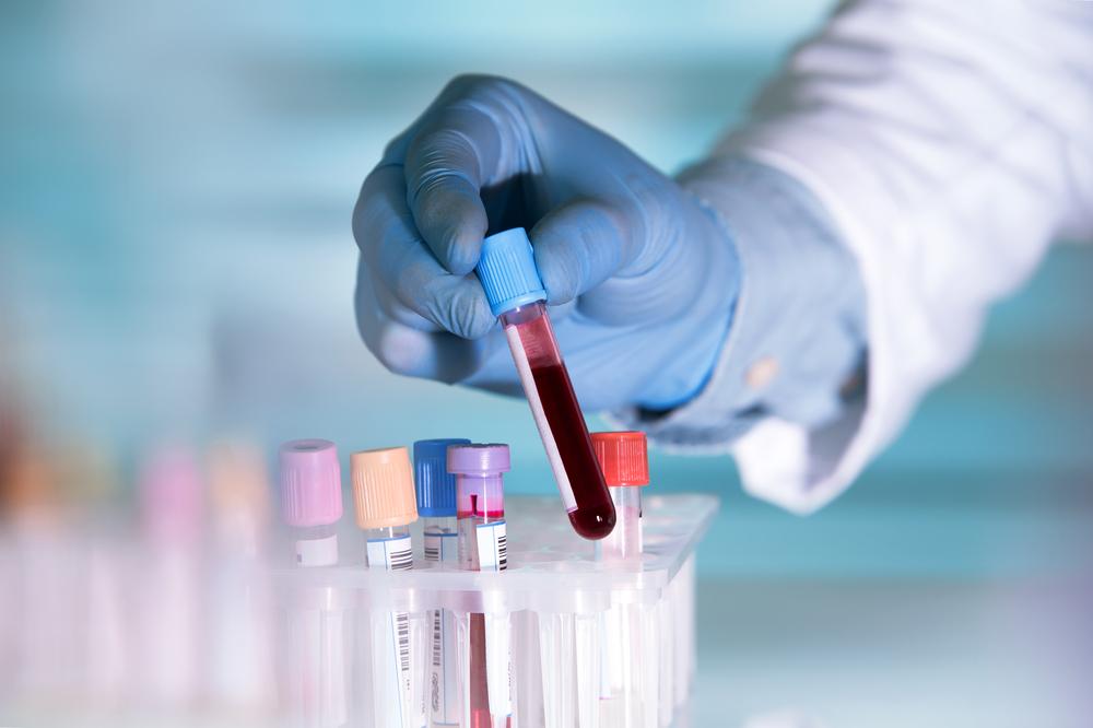 Antigen Karsinoembrionik