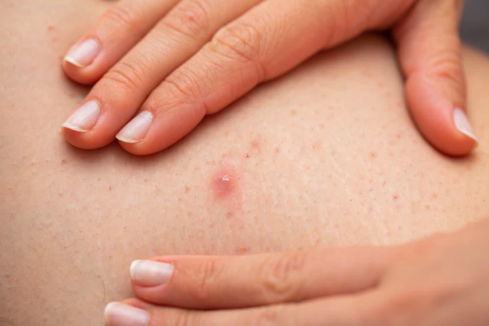 Folikulitis