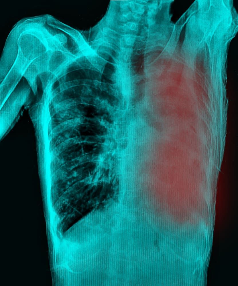 Efusi Pleura