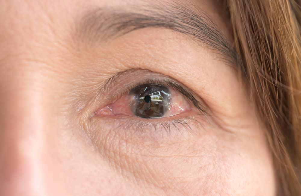 pterigium