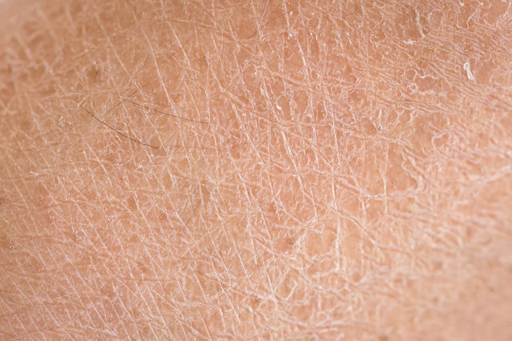 Iktiosis