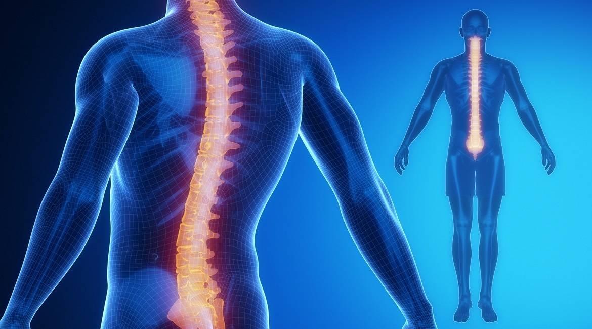 paraplegia