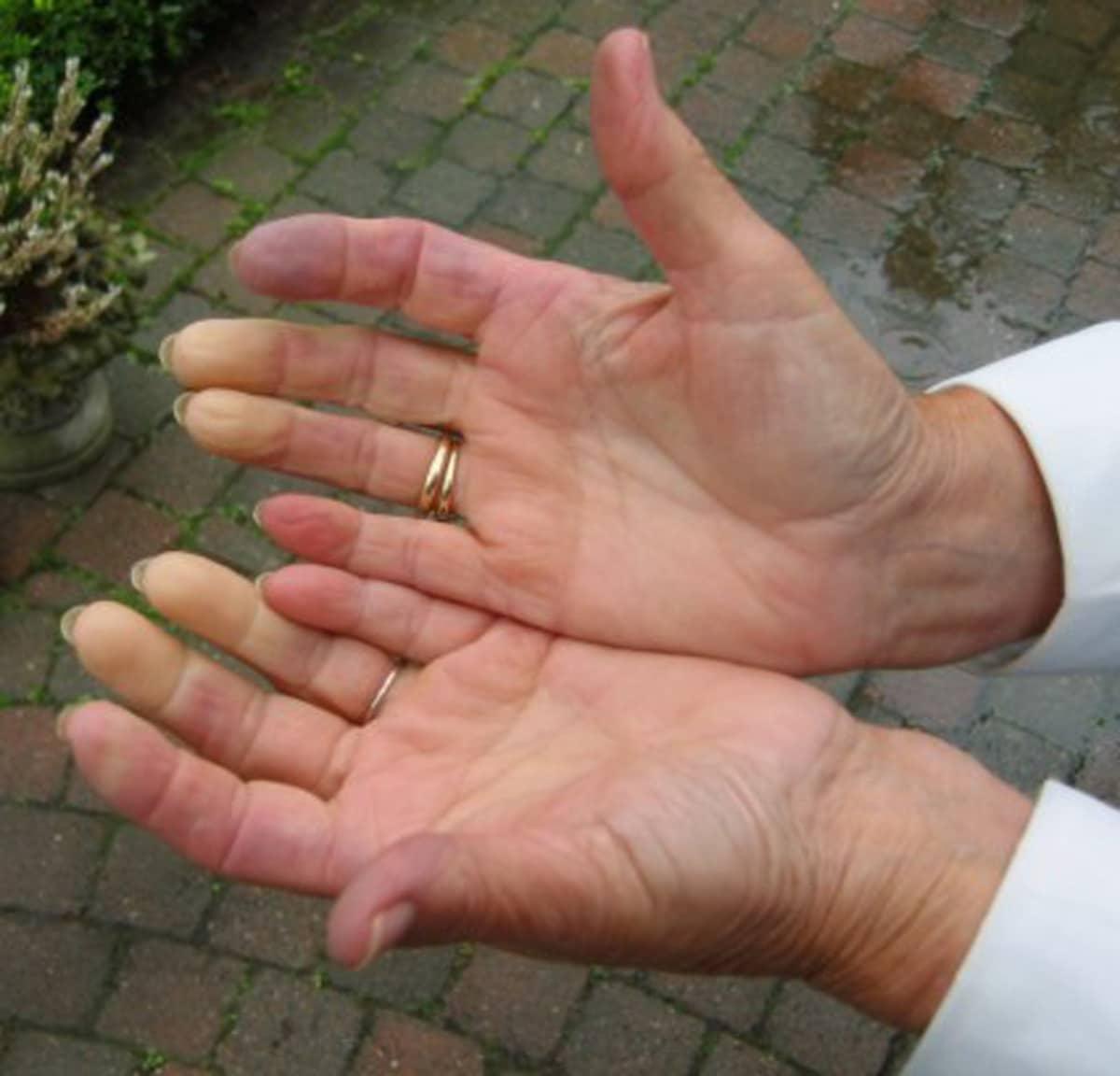Skleroderma
