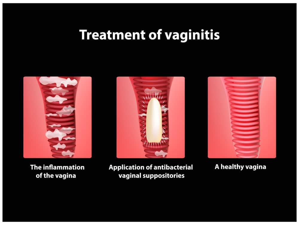 Vaginitis
