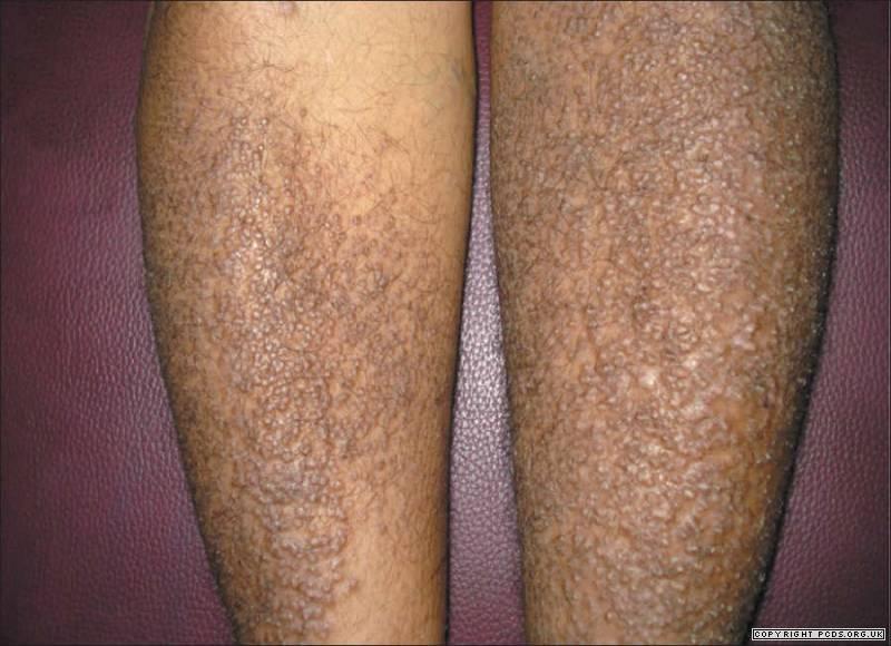 amiloidosis