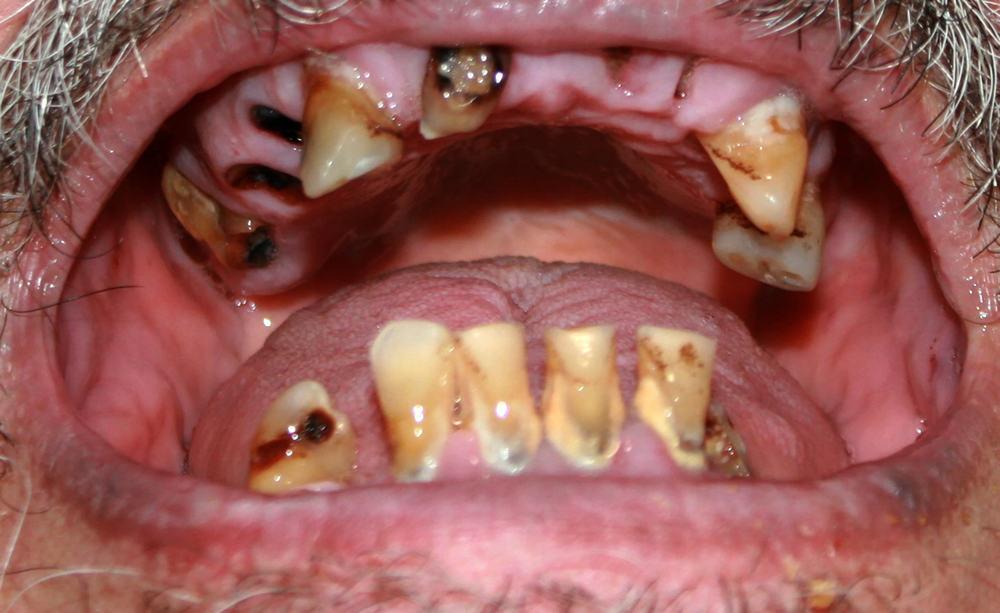 Meth Mouth (Pembusukan Gigi Karena Narkoba)