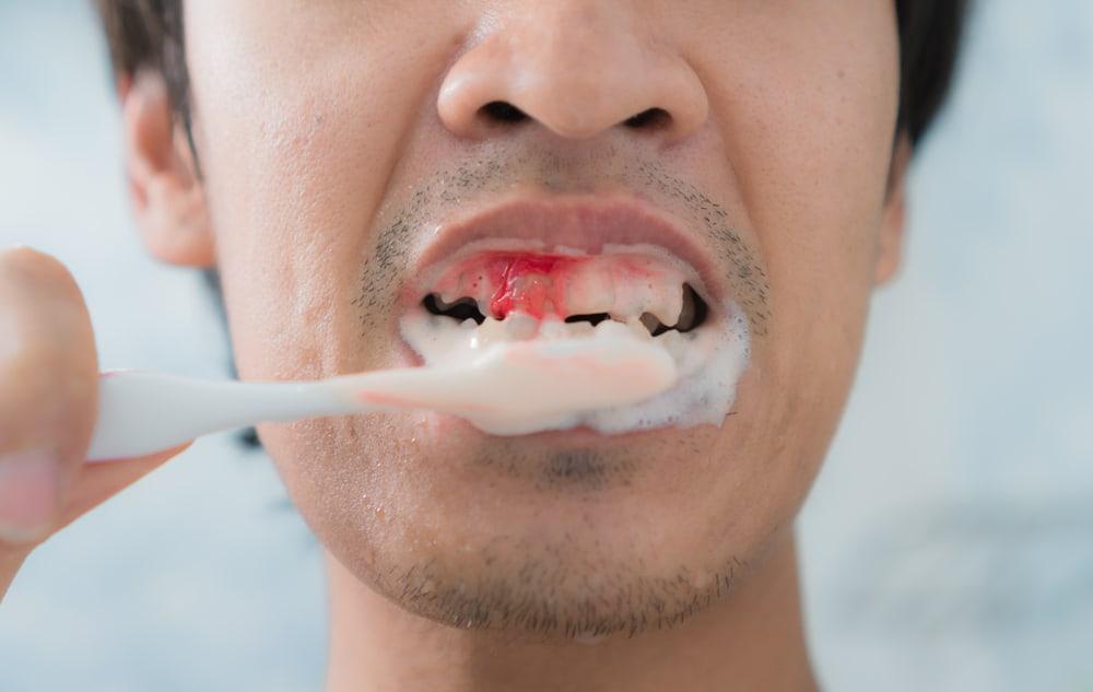 gusi-berdarah