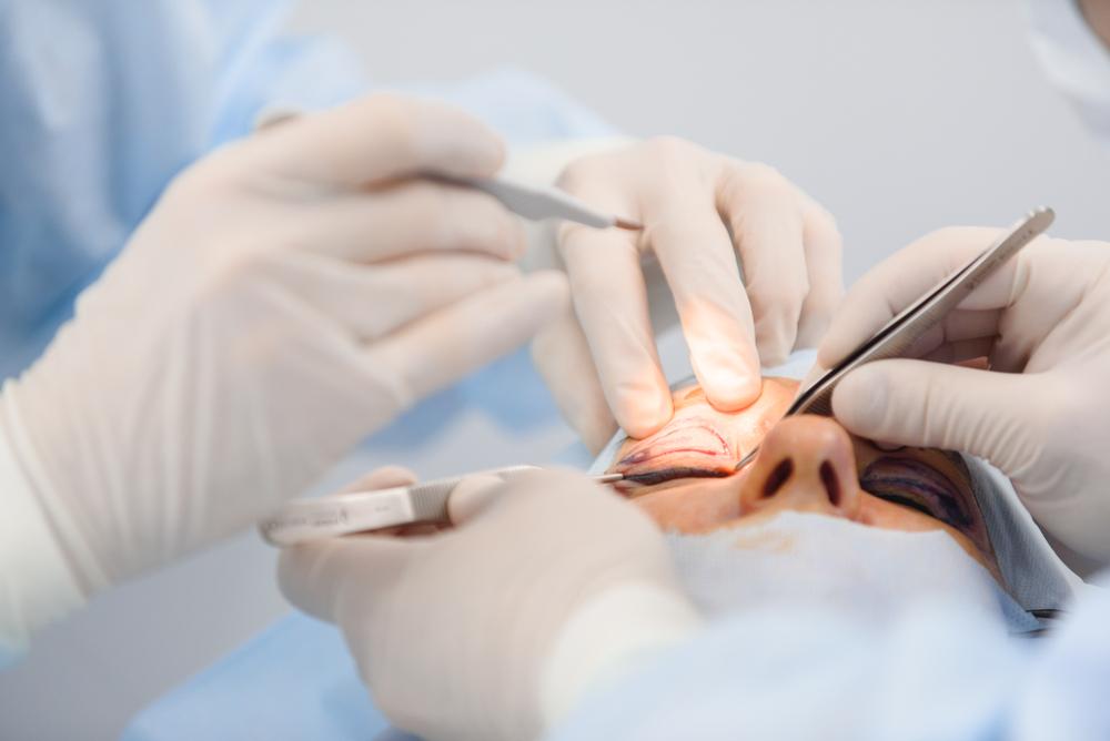 operasi-kelopak-mata