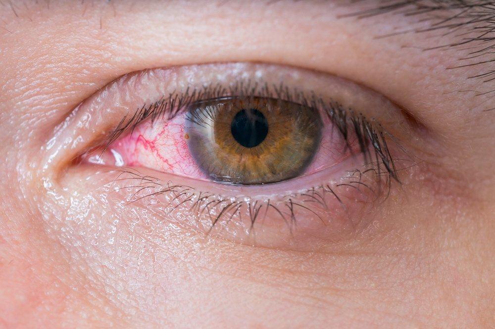 Alergi Mata (Konjungtivitis Alergi)