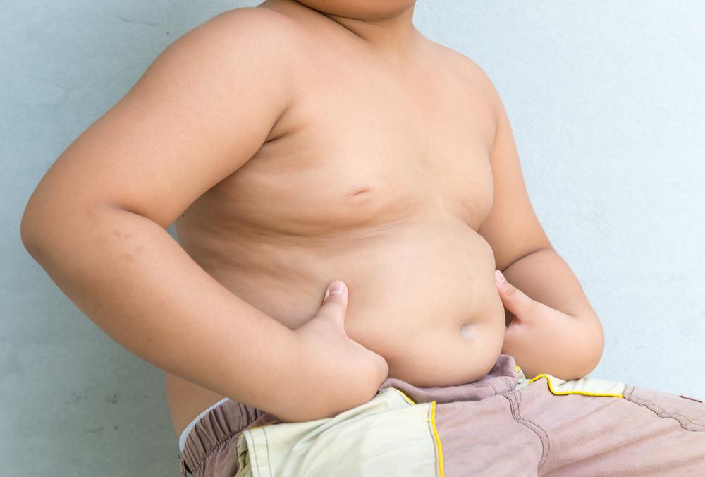 obesitas-pada-anak