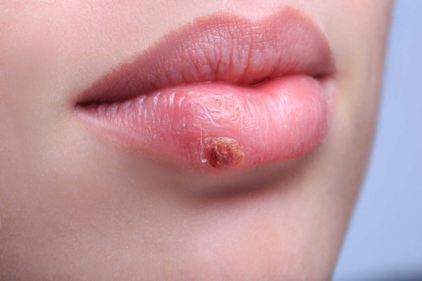 10 Hal Tak Terduga yang Menyebabkan Bibir Kering