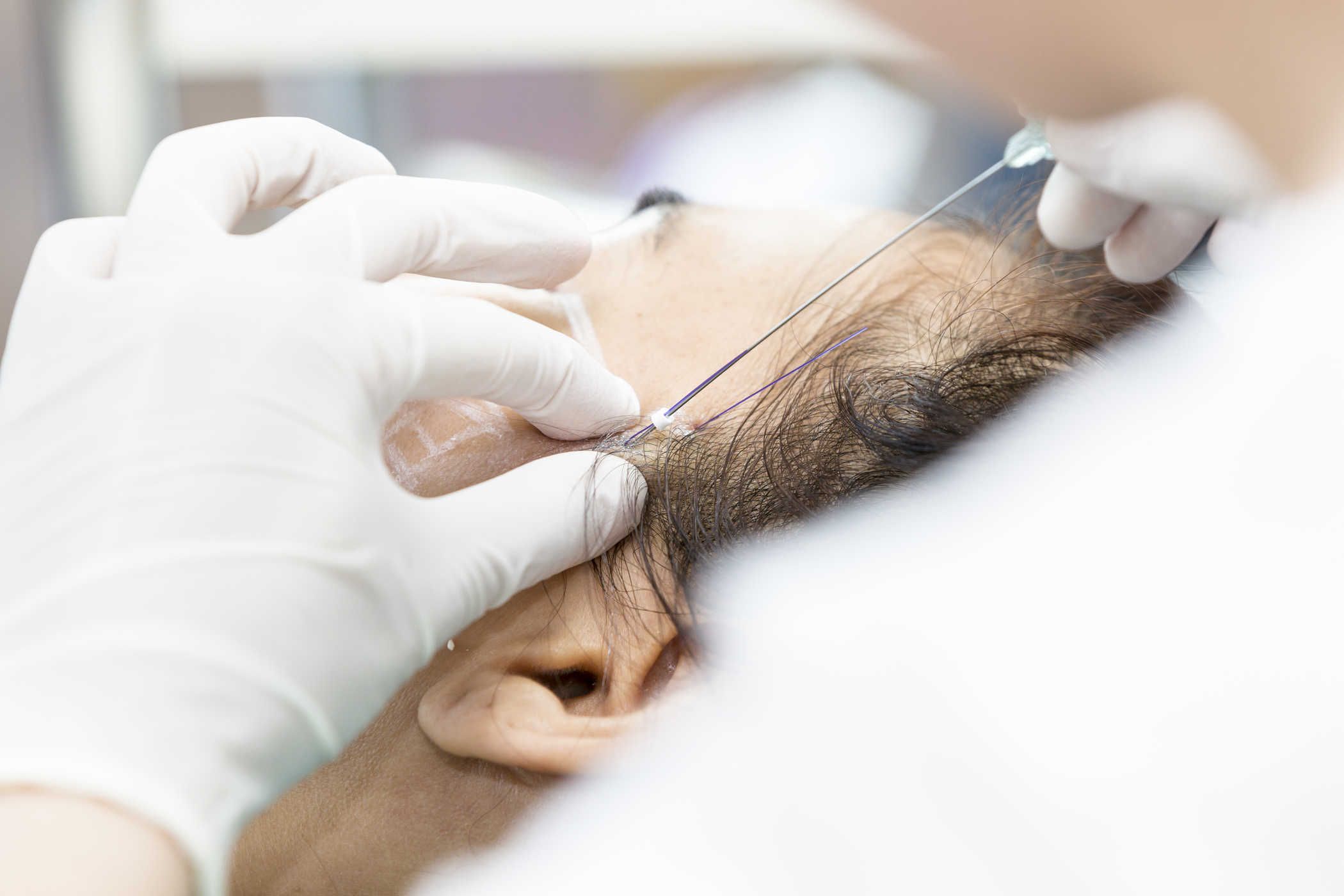 Thread Lift Alias Tanam Benang: Apa Manfaat dan Risikonya?