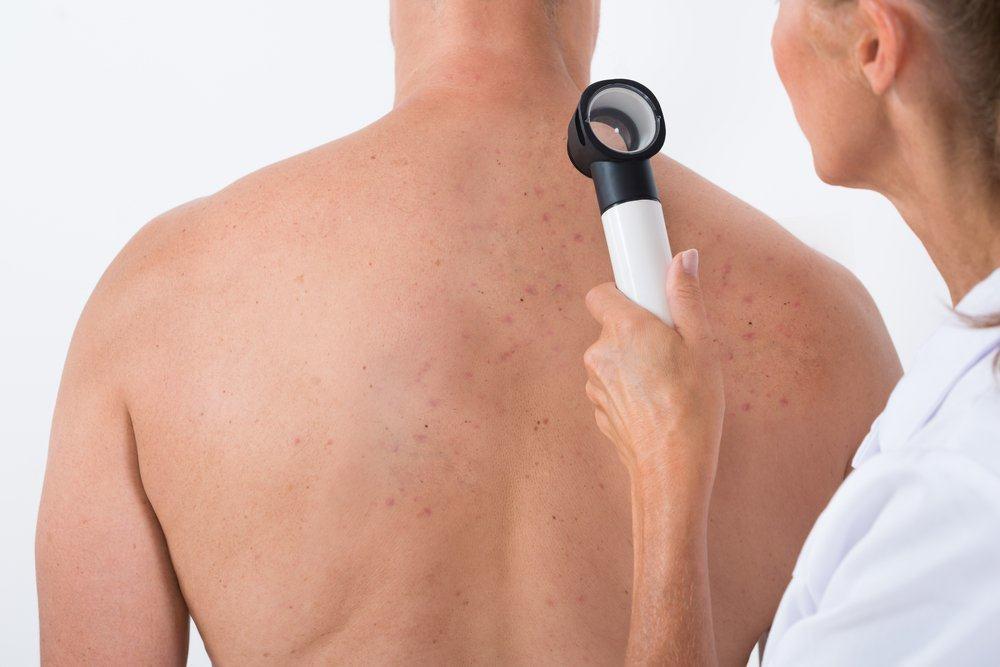 Jerawat di Badan: Dada, Punggung, Hingga Perut