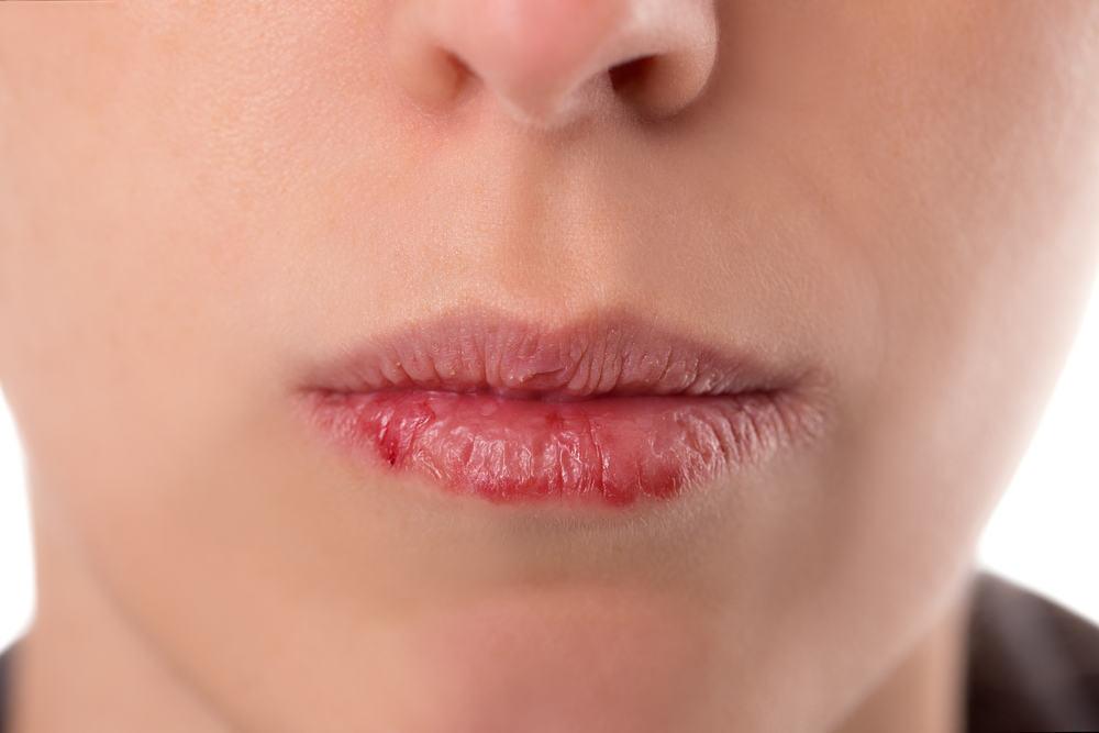cara-mengatasi-bibir-kering
