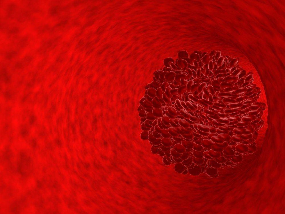 Amebiasis
