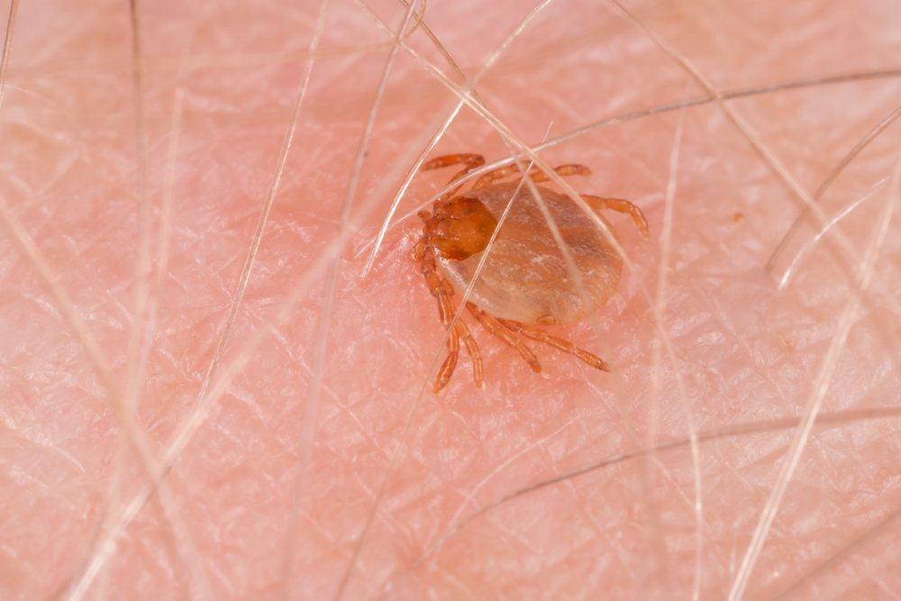 anaplasmosis
