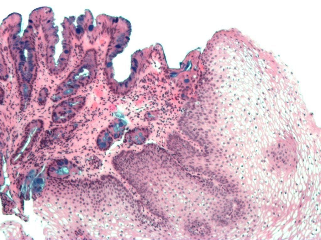 Barrett's Esophagus