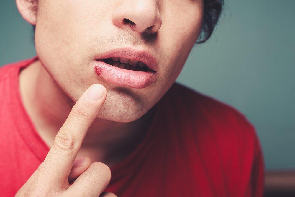 herpes-labialis