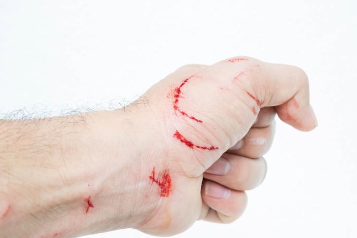 Cegah Kematian, Kenali Gejala Rabies pada Manusia dari Awal!